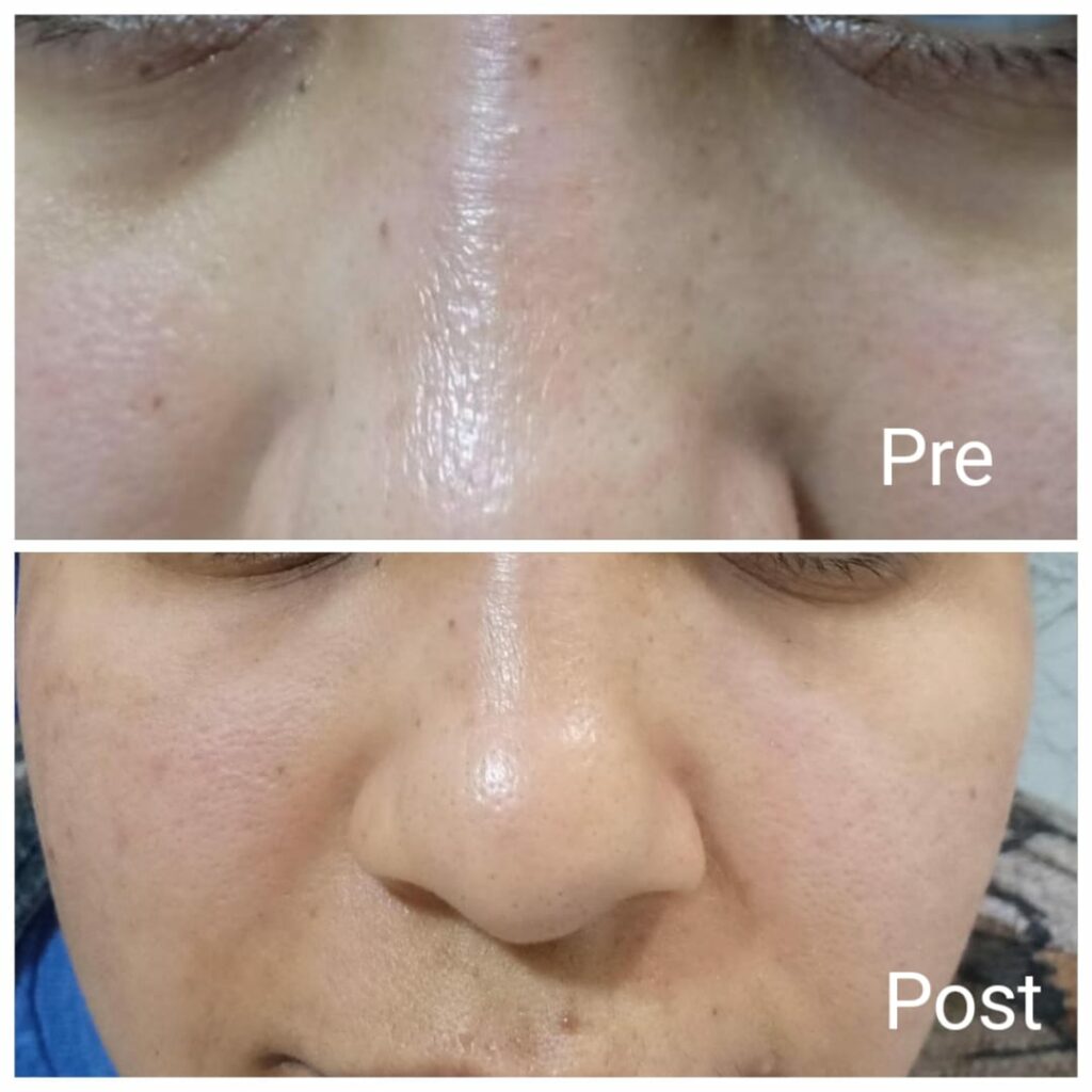 Remove dark circles at Nadara clinic in Hurghada